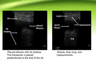 Pleural effusion with rib shadow.
The transducer is placed
perpendicular to the axis of the rib.
Muscle, fluid, lung, and
measurements.
 