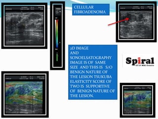CELLULAR
FIBROADENOMA
2D IMAGE
AND
SONOELSATOGRAPHY
IMAGE IS OF SAME
SIZE AND THIS IS S/O
BENIGN NATURE OF
THE LESION TSUK...