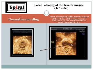 Normal levator sling
Focal interruption in the normal contour
of the left side of the levator muscle .
(UNILATERAL LEVATOR ATROPHY LEADING TO
PELVIC FLOOR DYSFUNCTION.)
Focal atrophy of the levator muscle
( left side )
 