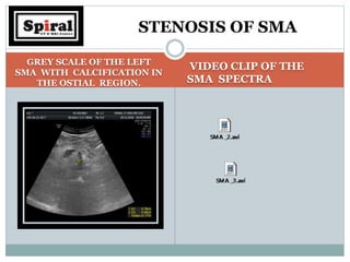 GREY SCALE OF THE LEFT
SMA WITH CALCIFICATION IN
THE OSTIAL REGION.
VIDEO CLIP OF THE
SMA SPECTRA
STENOSIS OF SMA
 