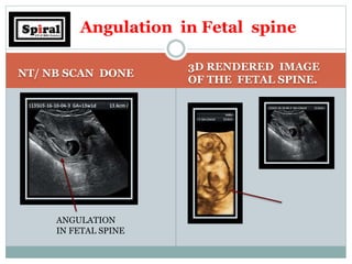 NT/ NB SCAN DONE
3D RENDERED IMAGE
OF THE FETAL SPINE.
Angulation in Fetal spine
ANGULATION
IN FETAL SPINE
 