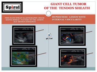 FREE HAND STRAIN ELASTOGRAPHY IMAGE
SHOWS MOSIAC PATTERN OF THE LESION
(S/O BENIGN ETIOLOGY)
HYPOECHOIC LESION WITH
INTERNAL VASCULARITY
GIANT CELL TUMOR
OF THE TENDON SHEATH
 