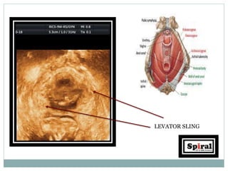 LEVATOR SLING
 