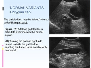 NORMAL VARIANTS
Phrygian cap
Figure (A) A folded gallbladder is
difficult to examine with the patient
supine.
(B) Turning the patient, right side
raised, unfolds the gallbladder,
enabling the lumen to be satisfactorily
examined.
The gallbladder may be ‘folded’ (the so-
called Phrygian cap).
 