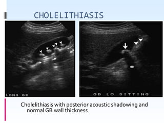 CHOLELITHIASIS
Cholelithiasis with posterior acoustic shadowing and 
normal GB wall thickness
 