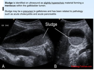 Sludge is identified on ultrasound as slightly hyperechoic material forming a
meniscus within the gallbladder lumen.
Sludge may be a precursor to gallstones and has been related to pathology
such as acute cholecystitis and acute pancreatitis
08/03/14
 