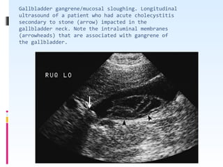Gallbladder gangrene/mucosal sloughing. Longitudinal
ultrasound of a patient who had acute cholecystitis
secondary to stone (arrow) impacted in the
gallbladder neck. Note the intraluminal membranes
(arrowheads) that are associated with gangrene of
the gallbladder.
 
