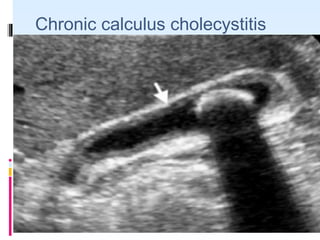 Chronic calculus cholecystitis
 