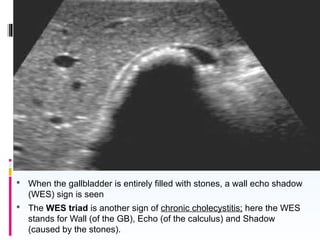  When the gallbladder is entirely filled with stones, a wall echo shadow
(WES) sign is seen
 The WES triad is another sign of chronic cholecystitis; here the WES
stands for Wall (of the GB), Echo (of the calculus) and Shadow
(caused by the stones).
 