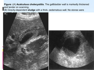 Figure :(A) Acalculous cholecystitis. The gallbladder wall is markedly thickened
and tender on scanning.
(B) Gravity-dependent sludge with a thick, oedematous wall. No stones were
present.
 