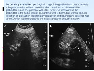 Porcelain gallbladder. (A) Sagittal imageof the gallbladder shows a densely
echogenic anterior wall (arrow) with a sharp shadow that obliterates the
gallbladder lumen and posterior wall. (B) Transverse ultrasound of the
gallbladder in the same patient. The anterior wall is bright, but, without enough
reflection or attenuation to eliminate visualization of the lumen and posterior wall
(arrow), which is also echogenic and casts a posterior acoustic shadow.
 