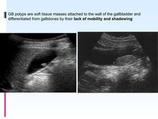 GB polyps are soft tissue masses attached to the wall of the gallbladder and
differentiated from gallstones by their lack of mobility and shadowing
 