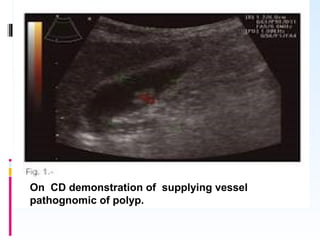 On CD demonstration of supplying vessel
pathognomic of polyp.
 
