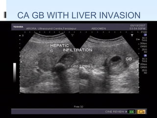 CA GB WITH LIVER INVASION
 