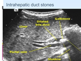 08/03/14
Intrahepatic duct stones
 
