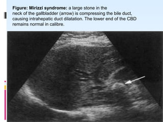 Figure: Mirizzi syndrome: a large stone in the
neck of the gallbladder (arrow) is compressing the bile duct,
causing intrahepatic duct dilatation. The lower end of the CBD
remains normal in calibre.
 