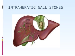 INTRAHEPATIC GALL STONES
 