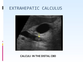 EXTRAHEPATIC CALCULUS
CALCULI IN THE DISTAL CBD
 