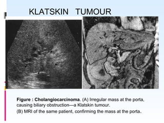 Figure : Cholangiocarcinoma. (A) Irregular mass at the porta,
causing biliary obstruction—a Klatskin tumour.
(B) MRI of the same patient, confirming the mass at the porta.
KLATSKIN TUMOUR
 