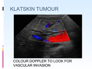 KLATSKIN TUMOUR
COLOUR DOPPLER TO LOOK FOR
VASCULAR INVASION
 