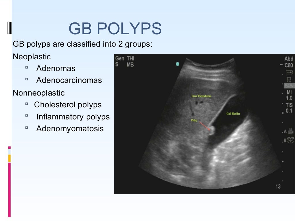 USG in gall bladder pathologies