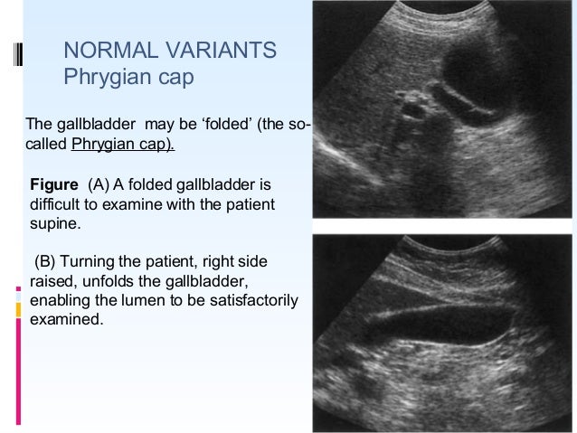 USG in gall bladder pathologies