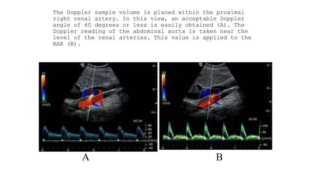 Ultrasound of renal hyperTension and Doppler findings | PPT
