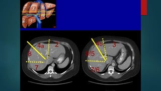 Liver Graph Ultrasonography of liver | PPTX