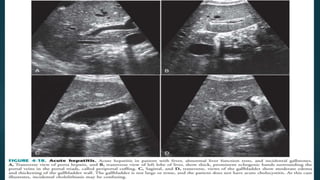 Liver Graph Ultrasonography of liver | PPTX
