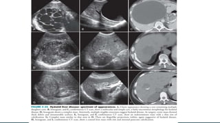 Liver Graph Ultrasonography of liver | PPTX