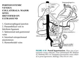 Liver cirrhosis USG | PPTX
