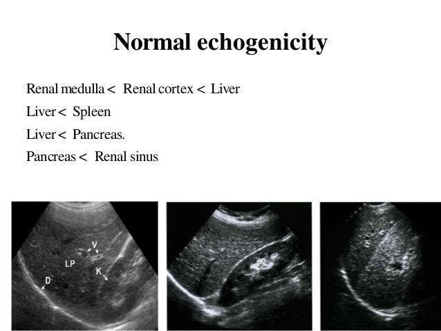 Liver cirrhosis USG Liver cirrhosis USG