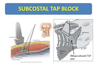 Tap Block Types Usg r nerve block | PPTX