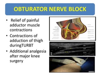 OBTURATOR NERVE BLOCK
• Relief of painful
adductor muscle
contractions
• Contractions of
adduction of thigh
duringTURBT
• Additional analgesia
after major knee
surgery
 