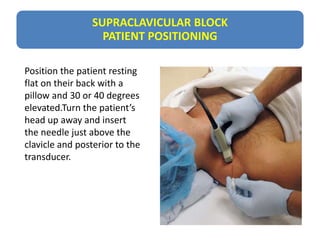 SUPRACLAVICULAR BLOCK
PATIENT POSITIONING
Position the patient resting
flat on their back with a
pillow and 30 or 40 degrees
elevated.Turn the patient’s
head up away and insert
the needle just above the
clavicle and posterior to the
transducer.
 