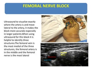 FEMORAL NERVE BLOCK
Femoral Artery
Femoral Vein
Femoral
Nerve
Ultrasound to visualize exactly
where the artery is and move...