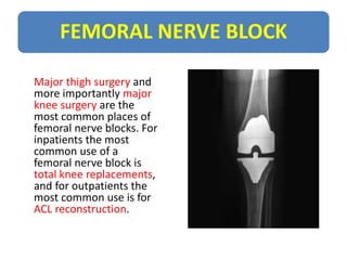 FEMORAL NERVE BLOCK
Major thigh surgery and
more importantly major
knee surgery are the
most common places of
femoral nerv...