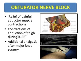 OBTURATOR NERVE BLOCK
• Relief of painful
adductor muscle
contractions
• Contractions of
adduction of thigh
duringTURBT
• ...