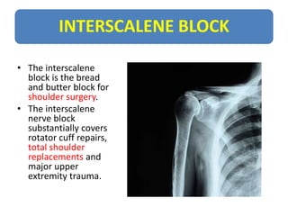 INTERSCALENE BLOCK
• This block targets higher at the roots of the
brachial plexus (C5, C6, +/- C7) in order to
reach the ...