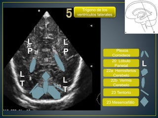 Plexos
Coroideos
20 Lóbulo
Parietal
22a Hemisferios
Cerebelo
22b Vermis
Cerebelo
23 Tentorio
Trígono de los
ventrículos laterales
L
P
L
P
L
PL
T L
T
23 Mesencefálo
 