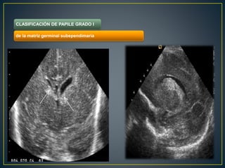 .
CLASIFICACIÓN DE PAPILE GRADO I
de la matriz germinal subependimaria
 