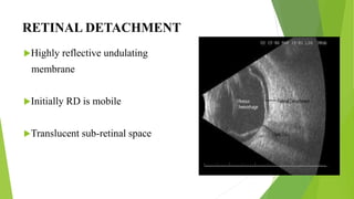 Retinal Undulation ULTRASONOGRAPHY (USG) AND ULTRASOUND BIOMICROSCOPY(UBM) | PPTX