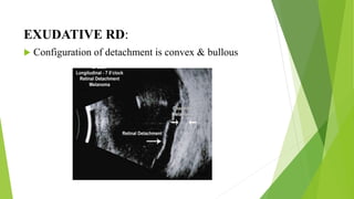 ULTRASONOGRAPHY (USG) AND ULTRASOUND BIOMICROSCOPY(UBM) | PPTX
