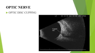 ULTRASONOGRAPHY (USG) AND ULTRASOUND BIOMICROSCOPY(UBM) | PPTX
