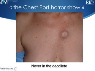 !
Never in the decollete
« the Chest Port horror show »
 