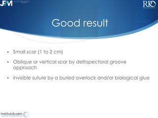 !
Good result
•  Small scar (1 to 2 cm)
•  Oblique or vertical scar by deltopectoral groove
approach
•  invisible suture b...