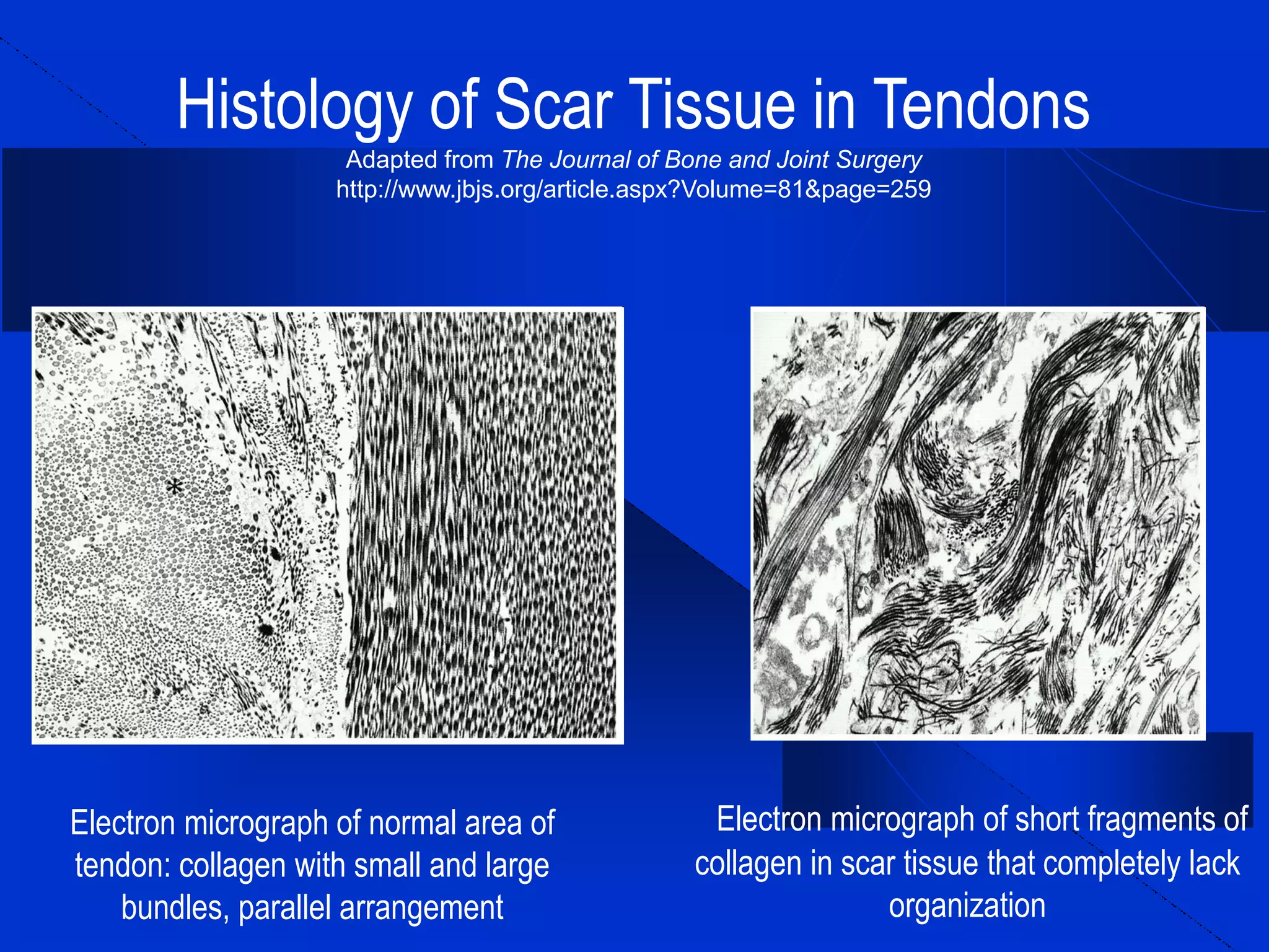 Ultrasound Guided Injectional Treatment of Scar Tissue, Bone Spurs, and ...