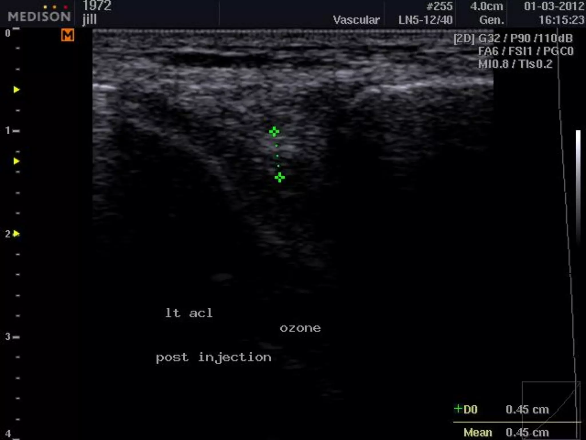 Ultrasound Guided Injectional Treatment of Scar Tissue, Bone Spurs, and ...