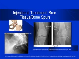 Spur Sign Radiological Ultrasound Guided Injectional Treatment of Scar Tissue, Bone Spurs, and ...