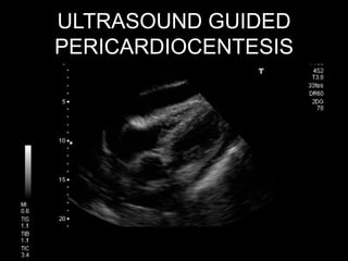 HENNEPIN COUNTY MEDICAL CENTER
EMERGENCY MEDICINE Every Life Matters
ULTRASOUND GUIDED
PERICARDIOCENTESIS
 